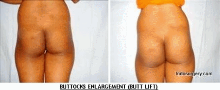 Buttocks Enlargement, Butt Implant, Butt Lift,  Buttocks Augmentation, Gluteal Lifts, Gluteoplasty, Gluteal Shaping