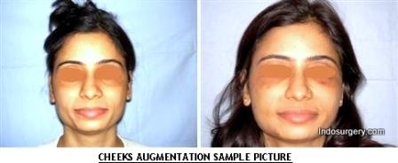 Cheeks Augmentation - Sample Picture