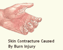Skin Contracture Caused By Burn