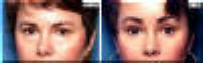 Eyelid Surgery - Blepharoplasty - Before And After