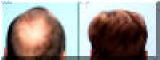 Hair Transplantation - Back - Before And After