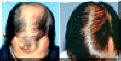 Hair Transplantation - Back And Front - Before And After