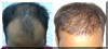 Hair Transplantation - Front - Before And After