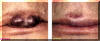 Hemangioma - Removal - Before And After