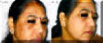 melasma - before and after lazer treatment - female