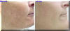 Lazer Facial - Before And After - Cheeks Spots & Smooth Skin