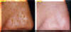 Lazer Facial - Before And After - Nose Spots & Skin