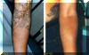 Tattoo Removed From Lower Arm - Before And After