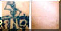 Tattoo Removed From Upper Arm - Before And After