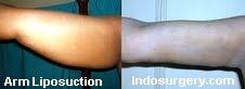 arm-liposuction-arm-tuck-brachioplasty-mumbai-india-delhi-indosurgery.com