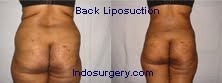 back-liposuction-mumbai-india-delhi-indosurgery.com