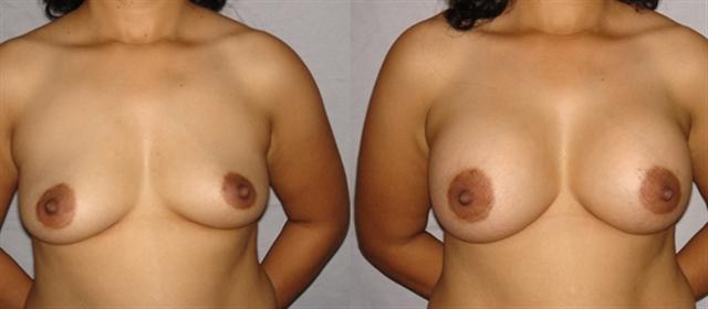 breast-silicon-implant-augmentation-mumbai-india-delhi