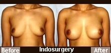 breast-augmentation-surgery-indosurgery
