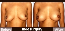 breast-augmentation-surgery-indosurgery