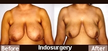 breast-reduction-liposuction-indosurgery-mumbai-india
