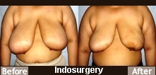 breast-reduction-liposuction-indosurgery-mumbai-india