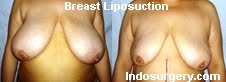 breast-liposuction-mumbai-india-delhi-indosurgery.com