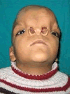 craniofacial cases