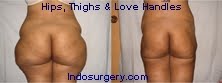 hips-thighs-love-handles-liposuction-mumbai-india-delhi-indosurgery.com