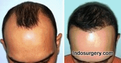 Hair Transplant Pictures - Before & After