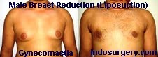 male-breast-reduction-surgery-mumbai-india-delhi-indosurgery.com