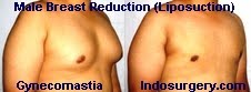 male-breast-liposuction-surgery-mumbai-india-delhi-indosurgery.com