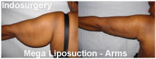 mega-liposuction-arms-indosurgery