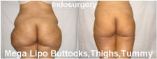 mega-liposuction-buttocks-thighs-tummy