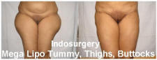 mega-liposuction-tummy-thighs-buttocks-indosurgery