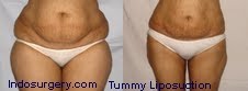 tummy-liposuction-mumbai-delhi-india-indosurgery.com
