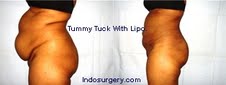 tummy-tuck-liposuction-mumbai-india-delhi-indosurgery.com