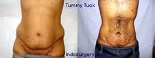 tummy-tuck-surgery-mumbai-india-delhi-indosurgery.com