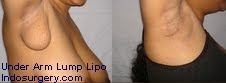 under-arm-lump-liposuction-axilla-mumbai-india-delhi-indosurgery.com