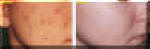 Pimples Removal - Before and After