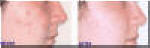 Pimples Removal - Before and After