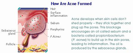 Genesis Of Pimples