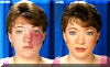 Birth Mark Removed From Face - Before And After