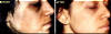Birth Mark Removed From Face - Before And After
