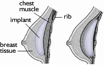 Female Breast Implant - How Done