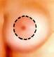 doughnut-mastopexy-india-mumbai-delhi-indosurgery