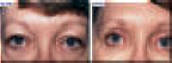 Eyelid Surgery - Blepharoplasty - Before And After