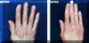 Rejuvenated Hands - Before And After