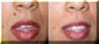 Mole Removed - Before And After