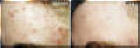 Lazer Facial - Before And After - Forehead Spots & Wrinkles
