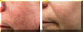 Lazer Facial - Before And After - Smmoth Facial Skin and Pores