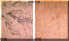 Spider Veins Removed - Before And After