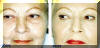 Face Wrinkles & Lines Removed - Before And After