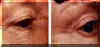 Loose Eyelid Skin Treated - Before And After