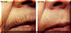 Lip Wrinkles And Lines Treated - Before And After