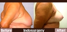 Mastopexy-Indosurgery